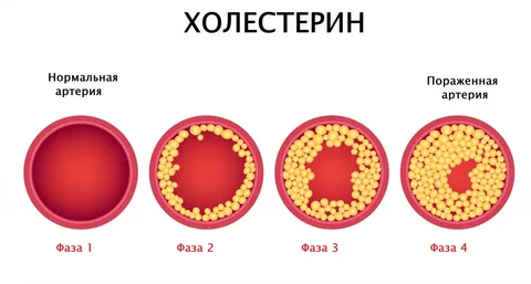 vysokiy holesterin v chem opasnost poleznaya informatsiya.webp.webp